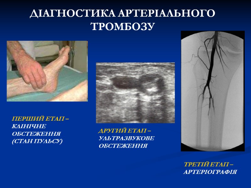 ДІАГНОСТИКА АРТЕРІАЛЬНОГО ТРОМБОЗУ ПЕРШИЙ ЕТАП – КЛІНІЧНЕ ОБСТЕЖЕННЯ (СТАН ПУЛЬСУ) ДРУГИЙ ЕТАП ДІАГНОСТИКА АРТЕРІАЛЬНОГО ТРОМБОЗУ ПЕРШИЙ ЕТАП – КЛІНІЧНЕ ОБСТЕЖЕННЯ (СТАН ПУЛЬСУ) ДРУГИЙ ЕТАП